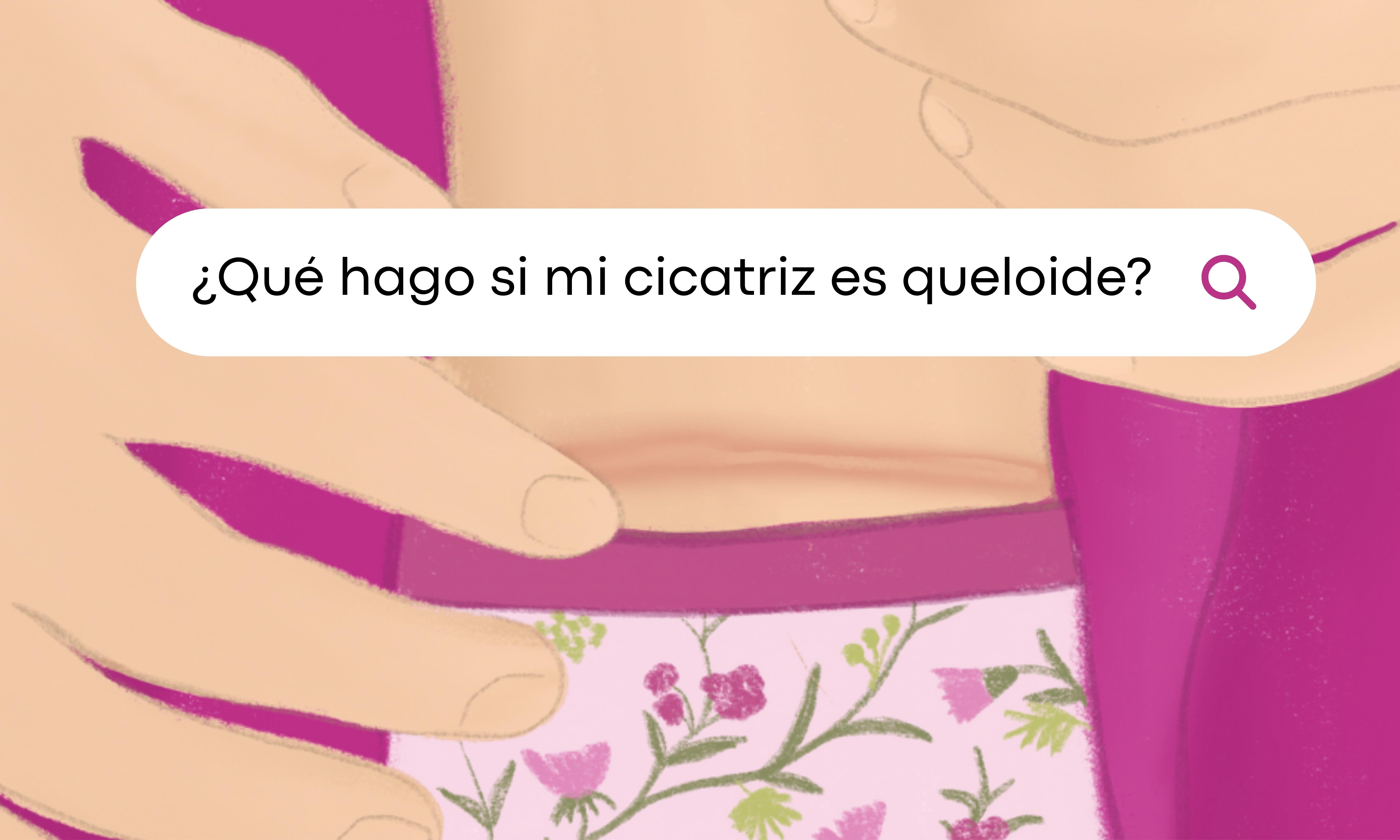 ¿Qué hago si mi cicatriz es queloide?