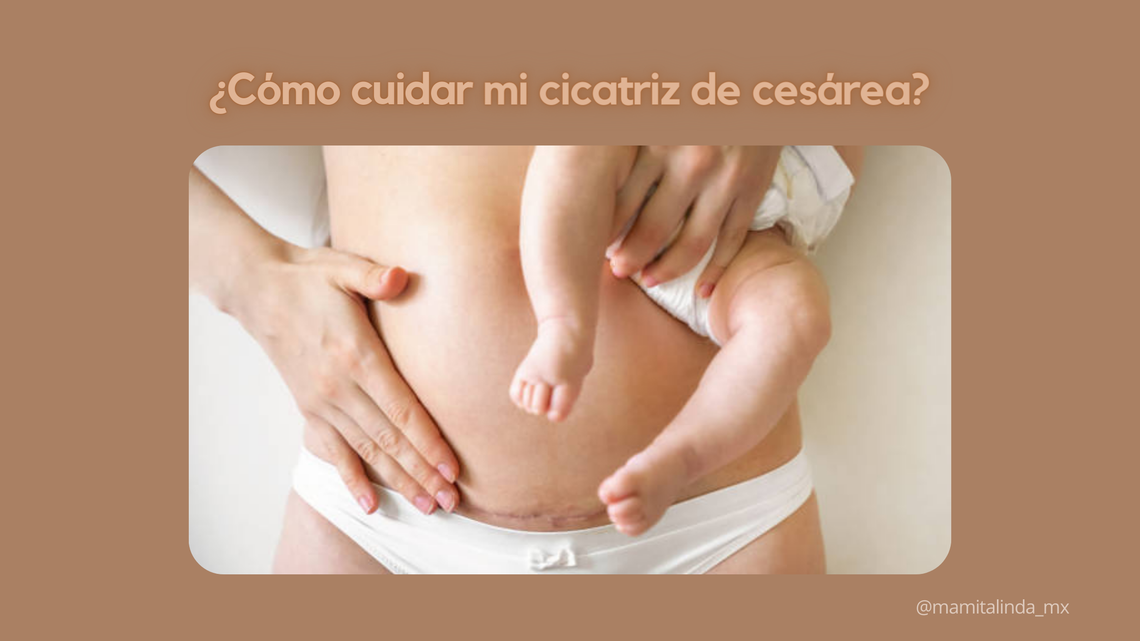 ¿Cómo cuidar mi cicatriz de cesárea?