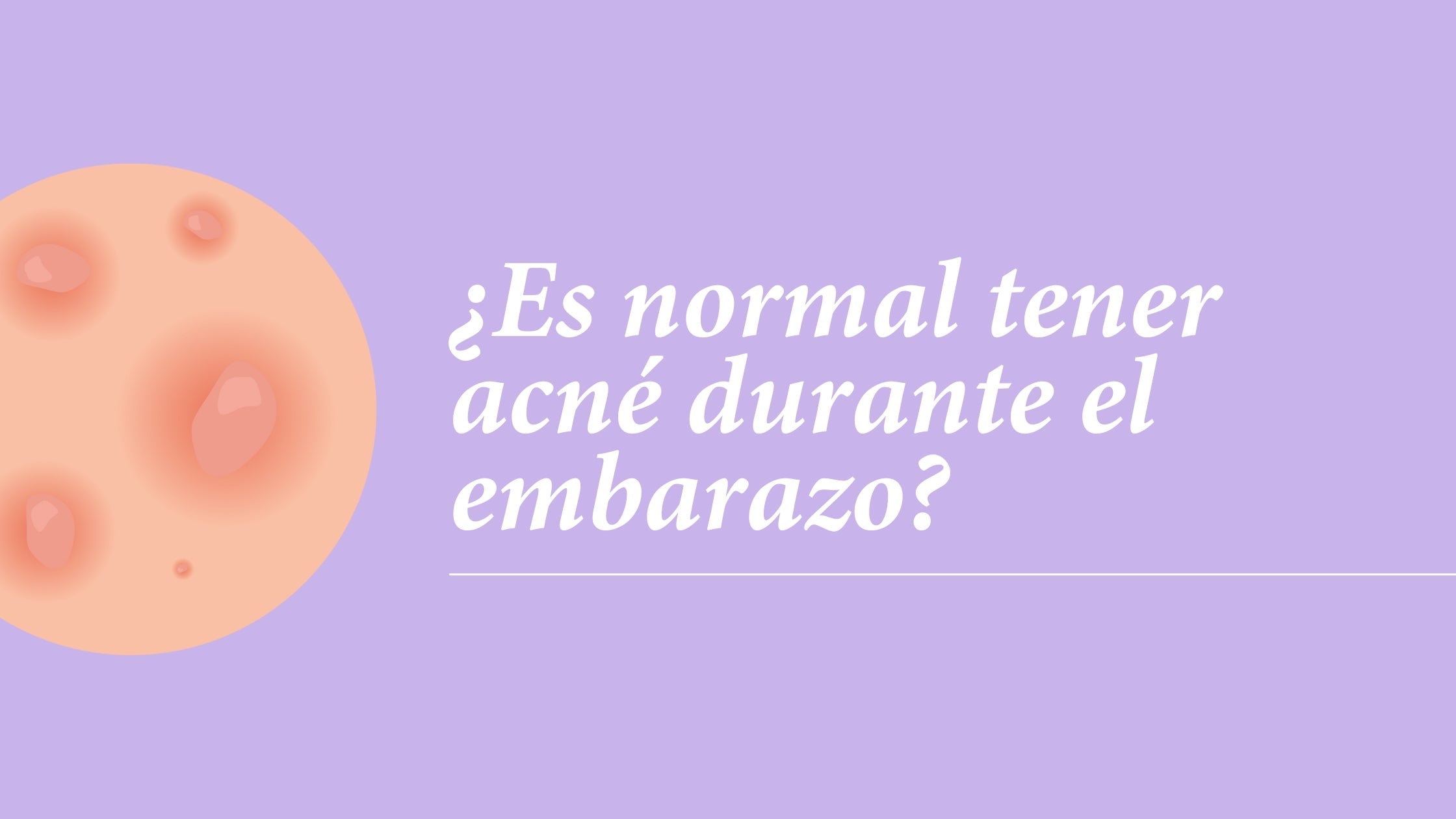 ¿Es normal tener acné durante el embarazo?