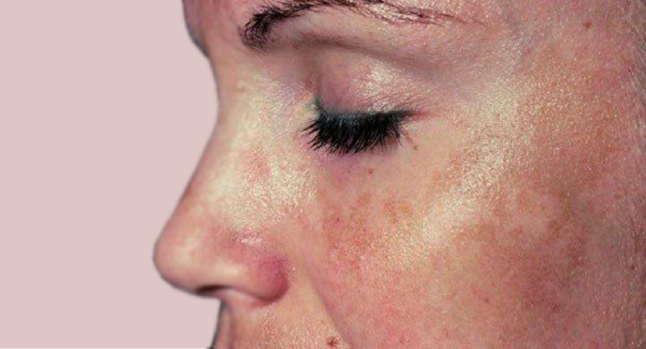 ¿Realmente se puede evitar el paño en el embarazo?