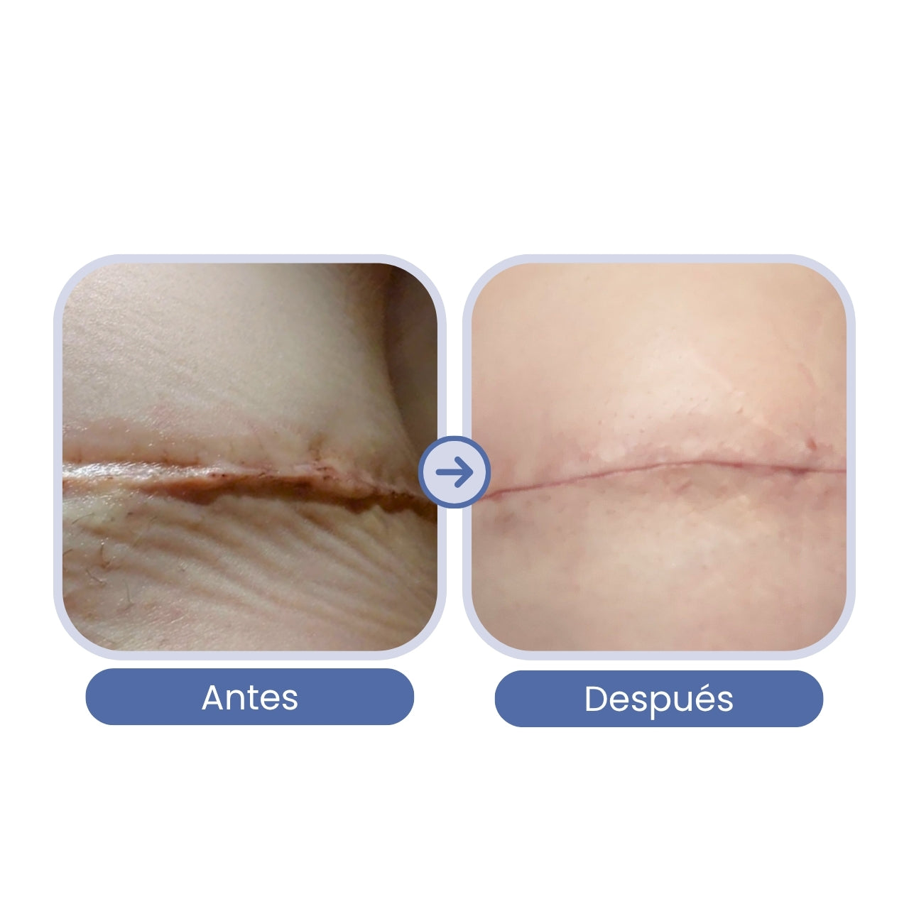 Incondicional "Queloide"